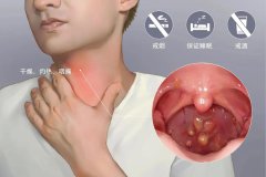 急性咽炎的病因病理-成都仁品耳鼻喉醫院分析