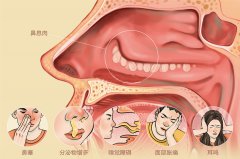 治療鼻息肉需要多少錢？成都仁品耳鼻喉醫院解答