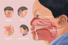 哪種治療方法療效好又省錢？成都仁品耳鼻喉醫院解答