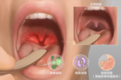 成都看咽喉醫院排名_咽喉炎的癥狀和危害