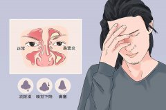 成都鼻竇炎的五大病因你了解嗎？