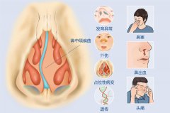 成都鼻中偏曲的危害大嗎？如何治療？
